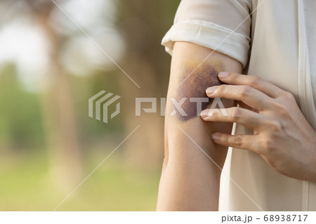 Sad asian female people showing a bruise in her arm,woman has bruises all over her body,caused by the abuse of a family or her husband violently attacked,being hit by a hard,bashing causes bruising Sad asian female people showing a bruise in her arm,woman has bruises all over her body,caused by the abuse of a family or her husband violently attacked,being hit by a hard,bashing causes bruising 68938717