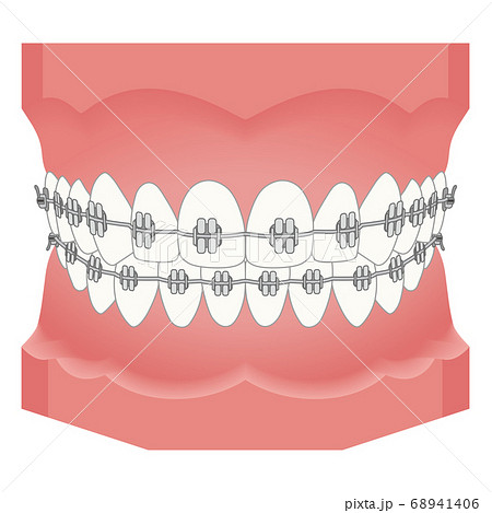 歯列矯正 矯正器具のイラスト素材