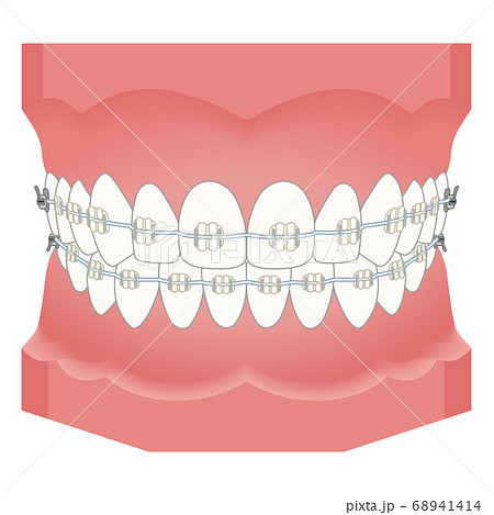 歯列矯正　矯正器具 68941414