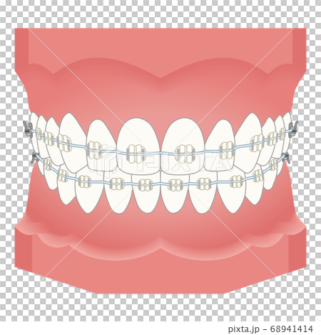 歯列矯正　矯正器具 68941414