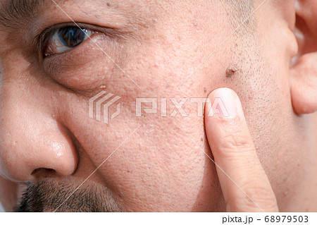 Closed up of big skin tags or Acrochordon on face Closed up of big skin tags or Acrochordon on face 68979503
