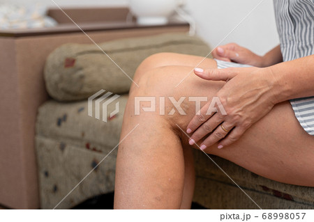 Woman at home with varicose veins. Healthcare problem, thrombophlebitis issue. Woman at home with varicose veins. Healthcare problem, thrombophlebitis issue. 68998057