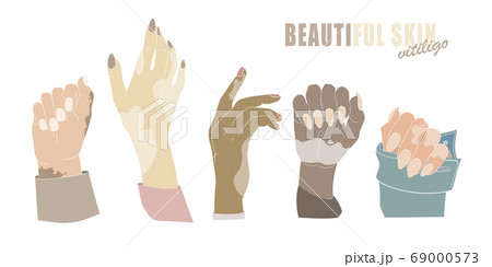 Hands with age spots or vitiligo isolated vector gestures genetic skin disease 69000573