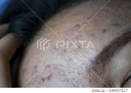 Acne skin problem on woman surface. worry about girl Acne skin problem on woman surface. worry about girl 69007827