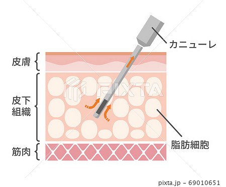 脂肪吸引法 皮膚断面図イラスト / 美容・ダイエット 脂肪吸引法 皮膚断面図イラスト / 美容・ダイエット 69010651
