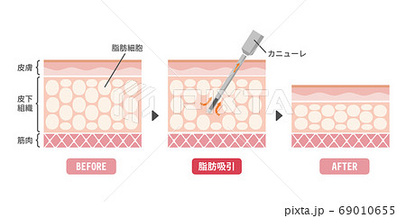 脂肪吸引法のビフォアアフター　皮膚断面図イラスト / 美容・ダイエット  69010655