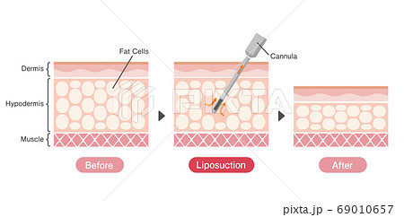脂肪吸引法のビフォアアフター 皮膚断面図イラスト / 美容・ダイエット (英語) 脂肪吸引法のビフォアアフター 皮膚断面図イラスト / 美容・ダイエット (英語) 69010657