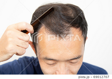 薄毛に悩む中年男性 薄毛に悩む中年男性 69012707