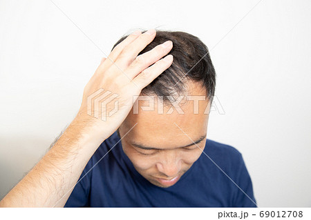薄毛に悩む中年男性 69012708