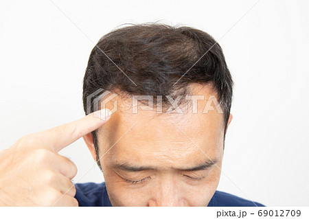 薄毛に悩む中年男性 69012709
