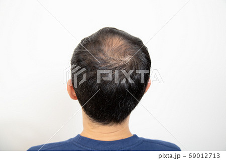 薄毛に悩む中年男性 69012713