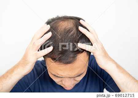 薄毛に悩む中年男性 薄毛に悩む中年男性 69012715