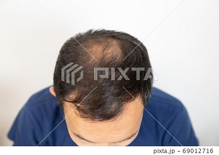 薄毛に悩む中年男性 薄毛に悩む中年男性 69012716