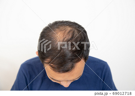 薄毛に悩む中年男性 薄毛に悩む中年男性 69012718