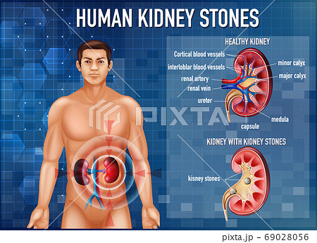 Informative illustration of kidney stones 69028056