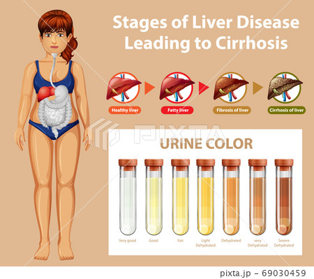 Stages of liver disease leading to Cirrhosis Stages of liver disease leading to Cirrhosis 69030459