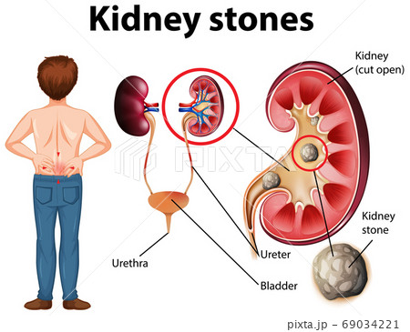 Comparison of healthy kidney and kidney with Comparison of healthy kidney and kidney with 69034221