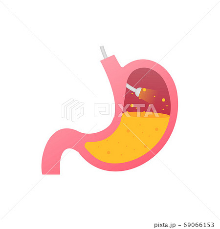 Stomach endoscopy. Endoscope in stomach through esophagus. Vector stock illustration. 69066153