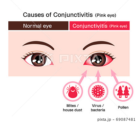 結膜炎と通常の目の比較イラスト（結膜炎の原因）/ 英語 69087481