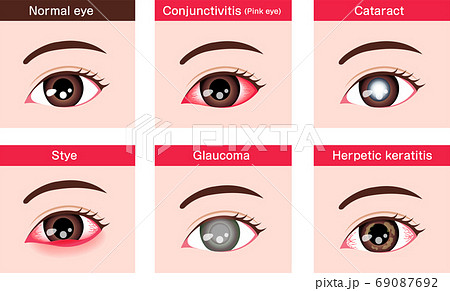 目 眼の病気 ベクターイラストセット 結膜炎 白内障 緑内障 Etc 英語のイラスト素材