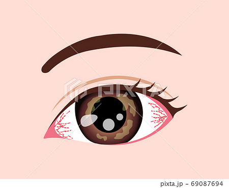 目 眼の病気 ベクターイラスト 角膜ヘルペス のイラスト素材