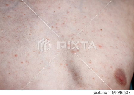 Close up image of a little boy's body suffering severe urticaria, nettle rash also called hives 69096683