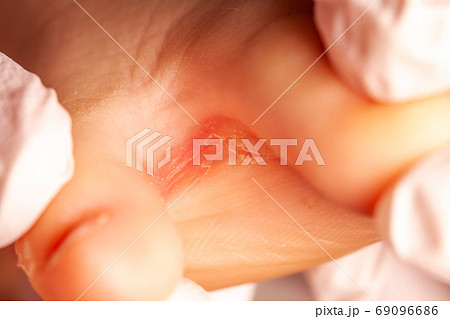Doctor little girl's foot with fungus infection 69096686