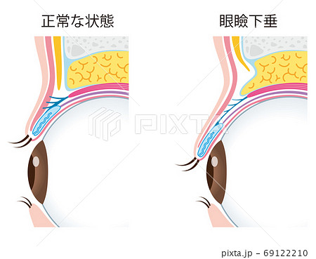 眼瞼下垂　瞼の構造　眼球　断面 69122210