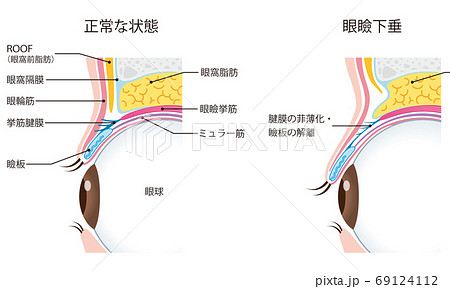 眼瞼下垂　瞼の構造　眼球　断面 69124112