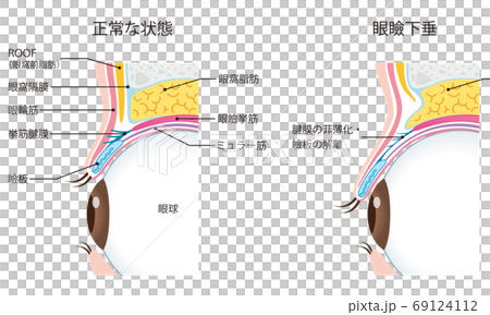 眼瞼下垂　瞼の構造　眼球　断面 69124112
