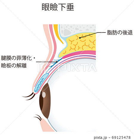 眼瞼下垂　瞼の構造　眼球　断面 69125478
