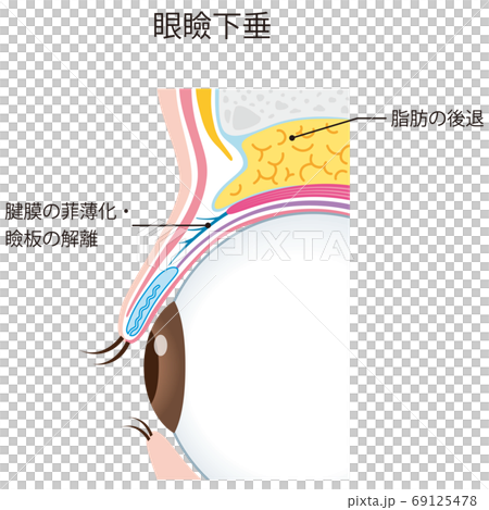 眼瞼下垂　瞼の構造　眼球　断面 69125478