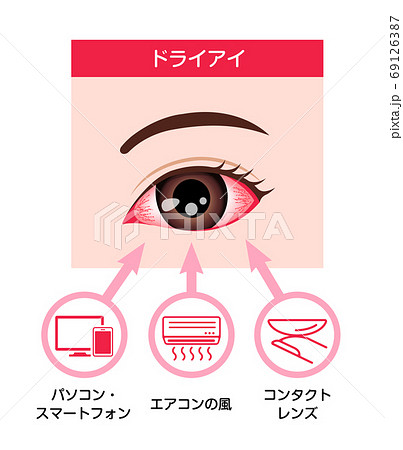 ドライアイの目 目の渇き 原因と症状 イラストのイラスト素材