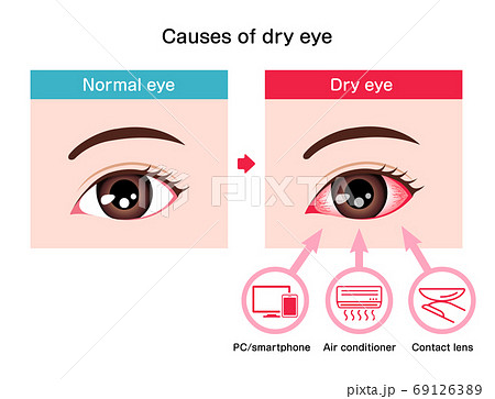 ドライアイの目 目の渇き 原因と症状 イラスト 英語 のイラスト素材