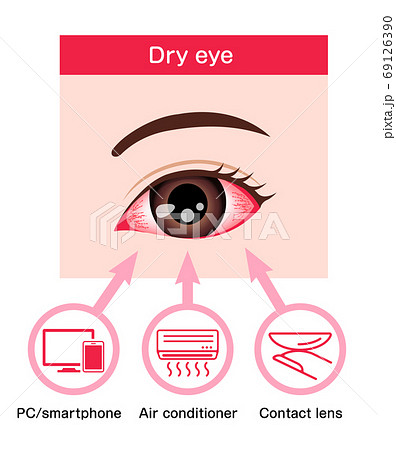 ドライアイの目 目の渇き 原因と症状 イラスト 英語 のイラスト素材