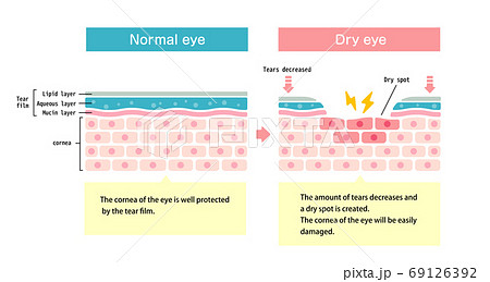 ドライアイの目 目の渇き 目の表面断面図イラスト 英語 のイラスト素材