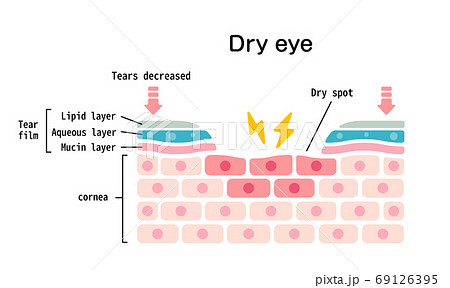 ドライアイの目の表面断面図イラスト 英語 のイラスト素材