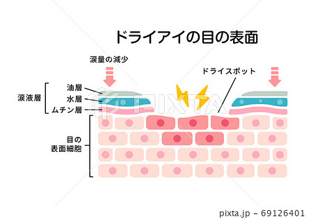 ドライアイの目の表面断面図イラスト 69126401
