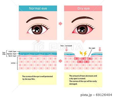 健康な目とドライアイの目の比較イラスト 英語 のイラスト素材