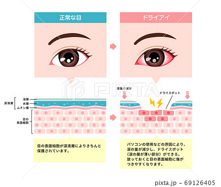 健康な目とドライアイの目の比較イラスト  69126405
