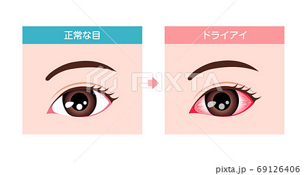 健康な目とドライアイの目の比較イラスト 69126406