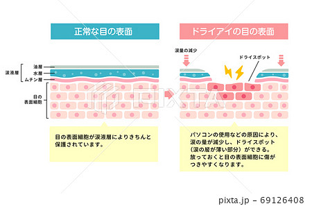 ドライアイの目・目の渇き 目の表面断面図イラスト 69126408