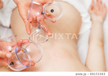 Vacuum medical cups in hands. 69153363