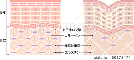健康な肌　しわ肌　断面図 69178474