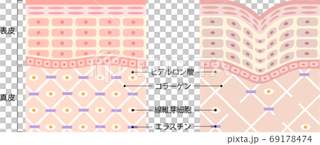 健康的皮膚皺紋皮膚橫斷面 69178474