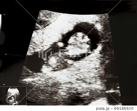 妊娠して9週目の胎児のエコー写真の写真素材