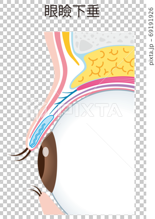 眼瞼下垂結構眼球截面 69191926