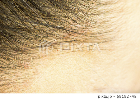 the hairline and on the scalp close up, dermatological diseases, skin problems 69192748