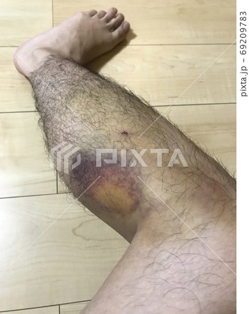 男性の足の打撲跡 69209783