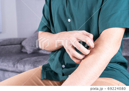 man scratching his arm while sitting on sofa at home. Healthcare medical or daily life concept. man scratching his arm while sitting on sofa at home. Healthcare medical or daily life concept. 69224080